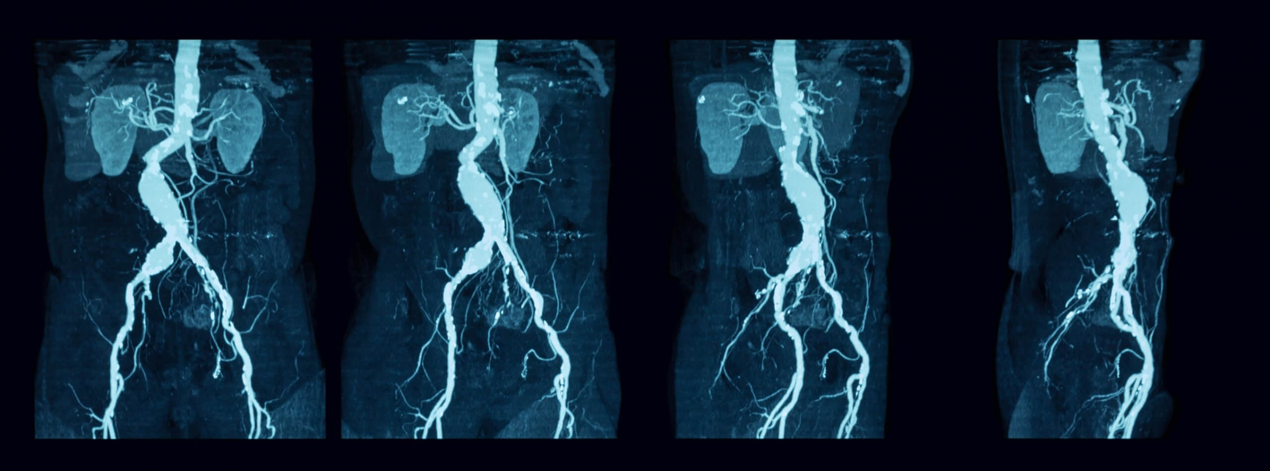 pulmonary-angiography-pha